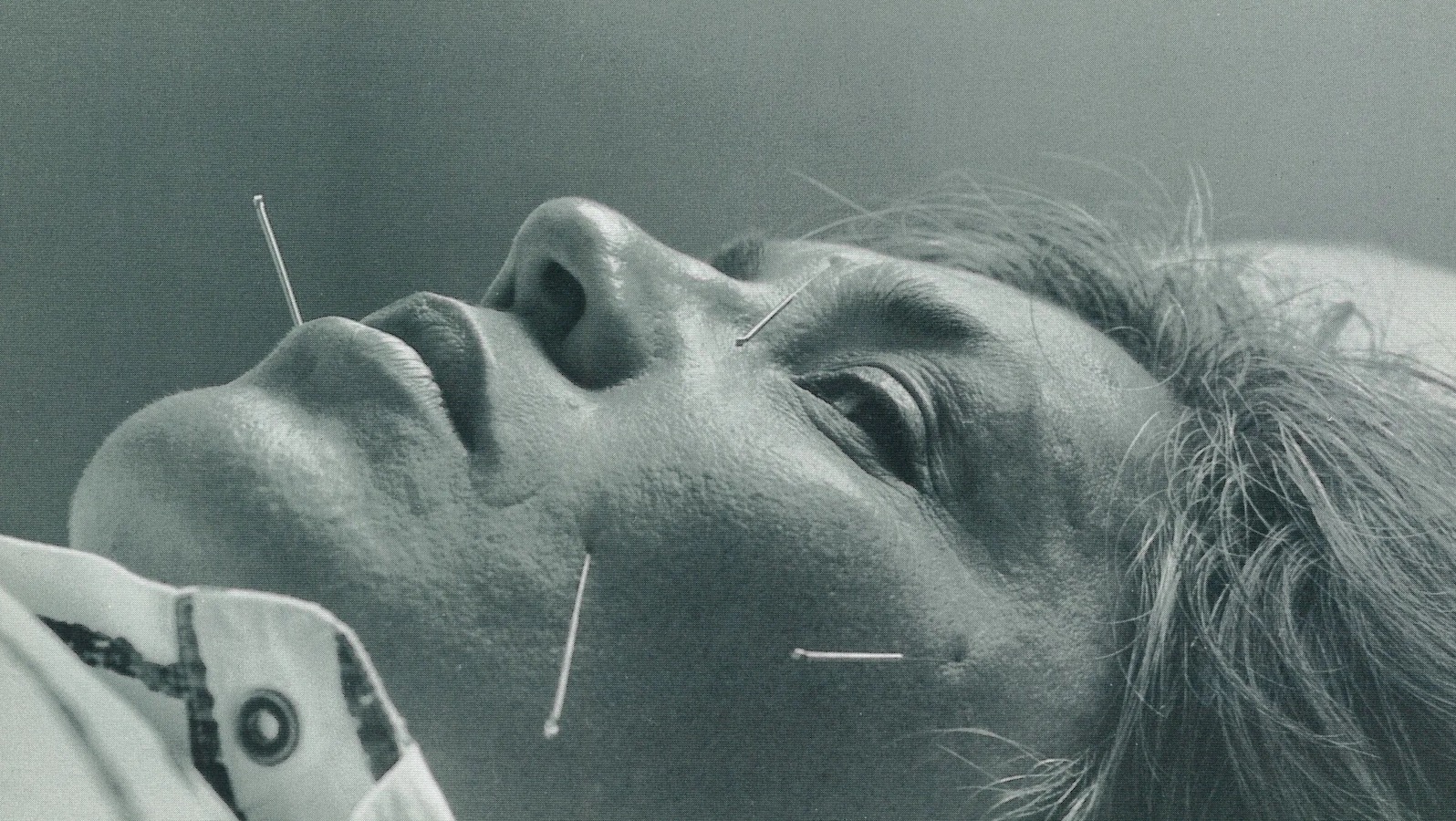Close-up of a face lying down with acupuncture needles sticking out in four spots.